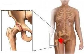 A csípőízület arthrosis kialakulásának okai