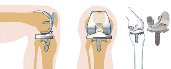 A térdízület endoprosttetika működése arthrosishoz