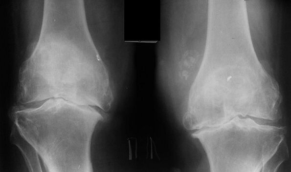 X -Gray a térdízület arthrosis diagnosztizálásának módjaként