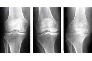 az ízület artrózisának szakaszai röntgenfelvételen