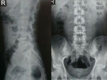 az ágyéki gerinc röntgenfelvétele